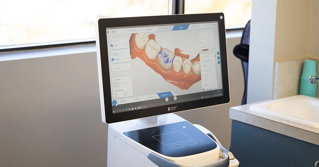 CEREC digital scanner showing a crown design in the operatory
